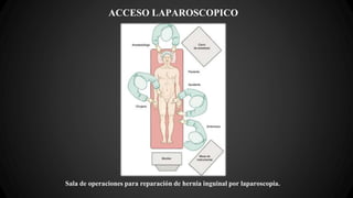 ACCESO LAPAROSCOPICO
Sala de operaciones para reparación de hernia inguinal por laparoscopia.
 