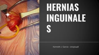 HERNIAS
INGUINALE
S
 
