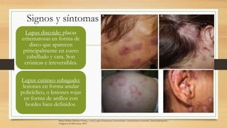 Signos y síntomas
Lupus discoide: placas
eritematosas en forma de
disco que aparecen
principalmente en cuero
cabelludo y cara. Son
crónicas e irreversibles.
Lupus cutáneo subagudo:
lesiones en forma anular
policíclico, o lesiones rojas
en forma de anillos con
bordes bien definidos.
Mayra Paulina Martínez-Godoy, y cols, Lupus Eritematoso Generalizado: Características Generales, Inmunopatogenia y
Antígenos de Relevancia, 2012
 