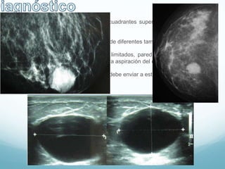  EF: nódulos de diversos tamaños, cuadrantes superiores externos, bordes y
superficie definidos y poco móvil
 Mamografía: patrón nodular bilateral de diferentes tamaños
 Ecografía: nódulos anecóicos, bien limitados, pared fina y refuerzo acústico
posterior, puede servir como guía para aspiración del quiste
 Contenido sanguinolento o turbio se debe enviar a estudio citológico
 