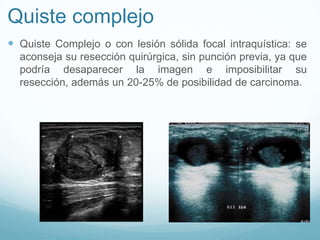Quiste complejo
 Quiste Complejo o con lesión sólida focal intraquística: se
aconseja su resección quirúrgica, sin punción previa, ya que
podría desaparecer la imagen e imposibilitar su
resección, además un 20-25% de posibilidad de carcinoma.
 