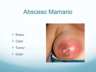 Absceso Mamario
 Rubor
 Calor
 Tumor
 Dolor
 