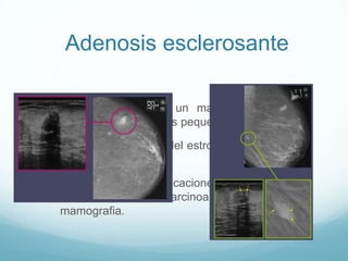 Adenosis esclerosante
 Es la aparicion de un mayor numero de
conductillos terminales pequeños o acinos.
 Es una proliferacion del estroma que produce
una lesion histica.
 Puede haber calcificaciones que pueden
confundirse con un carcinoa intraductal en la
mamografia.
 