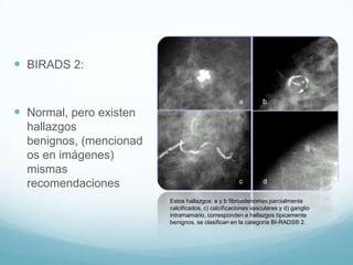  BIRADS 2:
 Normal, pero existen
hallazgos
benignos, (mencionad
os en imágenes)
mismas
recomendaciones
Estos hallazgos: a y b fibroadenomas parcialmente
calcificados, c) calcificaciones vasculares y d) ganglio
intramamario, corresponden a hallazgos típicamente
benignos, se clasifican en la categoría BI-RADS® 2.
 