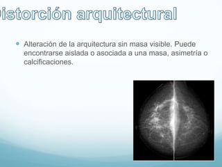  Alteración de la arquitectura sin masa visible. Puede
encontrarse aislada o asociada a una masa, asimetría o
calcificaciones.
 