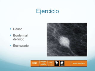 Ejercicio
 Denso
 Borde mal
definido
 Espiculado
 