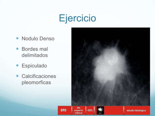 Ejercicio
 Nodulo Denso
 Bordes mal
delimitados
 Espiculado
 Calcificaciones
pleomorficas
 