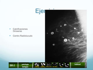 Ejercicio
 Calcificaciones
Groseras
 Centro Radiolucudo
 
