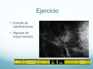 Ejercicio
 Cumulo de
calcificaciones
 Algunas de
mayor tamaño
 
