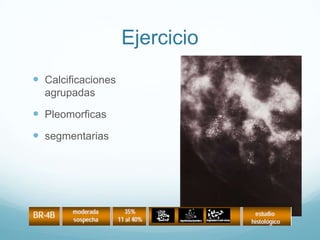 Ejercicio
 Calcificaciones
agrupadas
 Pleomorficas
 segmentarias
 