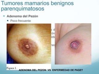 Tumores mamarios benignos
parenquimatosos
 Adenoma del Pezón
 Poco frecuente
 Edad promedio 40-45 años.
 Nódulo sólido de limites netos de menos de 1
cm dentro del cuerpo del pezón que al crecer
puede causar erosión de la epidermis e incluso
ulceración por compresión.
 Diagnostico diferencial: Enfermedad de Paget.
ADENOMA DEL PEZON VS ENFERMEDAD DE PAGET
 