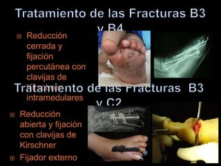    Reducción
        cerrada y
        fijación
        percutánea con
        clavijas de
        Kirschner
        intramedulares
   Reducción
    abierta y fijación
    con clavijas de
    Kirschner
   Fijador externo
 