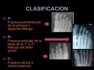 Fractura extraarticular
de la primera o
segunda falange


Fractura articular de la
base de la 1° o 2°
falange del dedo
gordo


Fractura de los 4
dedos externos
 