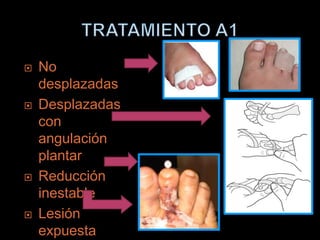    No
    desplazadas
   Desplazadas
    con
    angulación
    plantar
   Reducción
    inestable
   Lesión
    expuesta
 