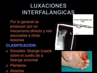 Por lo general se
    producen por un
    mecanismo directo y van
    asociadas a otras
    lesiones

   Dorsales: falange luxada
    sobre el cuello de a
    falange proximal
   Plantares
   Abiertas
 