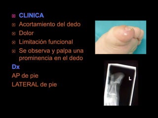    Acortamiento del dedo
   Dolor
   Limitación funcional
   Se observa y palpa una
    prominencia en el dedo

AP de pie
LATERAL de pie
 