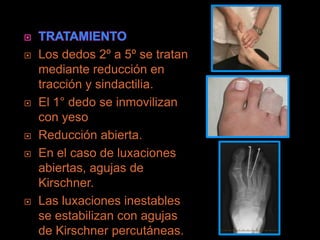    Los dedos 2º a 5º se tratan
    mediante reducción en
    tracción y sindactilia.
   El 1° dedo se inmovilizan
    con yeso
   Reducción abierta.
   En el caso de luxaciones
    abiertas, agujas de
    Kirschner.
   Las luxaciones inestables
    se estabilizan con agujas
    de Kirschner percutáneas.
 