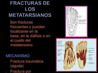 Son fracturas
    frecuentes y pueden
    localizarse en la
    base, en la diáfisis o en
    el cuello del
    metatarsiano.



-   Fractura traumática
    (aguda)
-   Fractura por
 