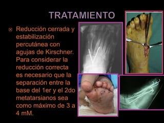   Reducción cerrada y
    estabilización
    percutánea con
    agujas de Kirschner.
    Para considerar la
    reducción correcta
    es necesario que la
    separación entre la
    base del 1er y el 2do
    metatarsianos sea
    como máximo de 3 a
    4 mM.
 