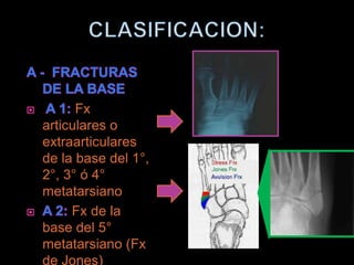 Fx
articulares o
extraarticulares
de la base del 1°,
2°, 3° ó 4°
metatarsiano
     Fx de la
base del 5°
metatarsiano (Fx
de Jones)
 