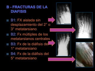 FX aislada sin
desplazamiento del 2° o
3° metatarsiano
    Fx múltiples de los
metatarsianos centrales
    Fx de la diáfisis del
1° metatarsiano
    Fx de la diáfisis del
5° metatarsiano
 