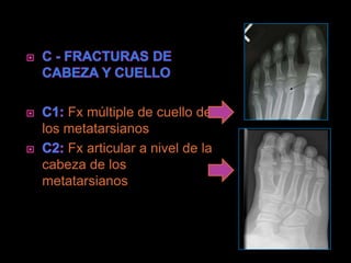 Fx múltiple de cuello de
los metatarsianos
    Fx articular a nivel de la
cabeza de los
metatarsianos
 