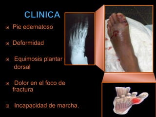    Pie edematoso

   Deformidad

   Equimosis plantar ó
    dorsal

    Dolor en el foco de
    fractura

   Incapacidad de marcha.
 