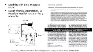 • Modificación de la mascara
facial.
• Evitar efectos secundarios, la
rotación maxilar hacia arriba y
adelante.
Alcan, Keles¸, and Erverdi. The effects of a modified protraction headgear on maxilla. Ajodo 2000;117:27-38
Sistema de fuerzas y momento en el diseño de aparato extraoral de
protracción reversa. Fuente: Alcan (2000)(37)
 