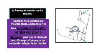 canino-molar por
arriba del plano
oclusal,
 