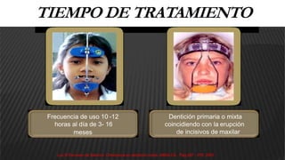 TIEMPO DE TRATAMIENTO
Frecuencia de uso 10 -12
horas al día de 3- 16
meses
Dentición primaria o mixta
coincidiendo con la erupción
de incisivos de maxilar
Luz D Escrivan de Saturno. Ortodoncia en dentición mixta. AMOLCA , Pag.267 - 276, 2007.
 
