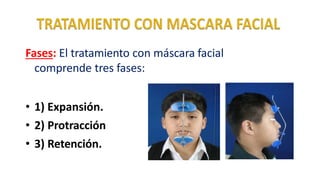 Fases: El tratamiento con máscara facial
comprende tres fases:
• 1) Expansión.
• 2) Protracción
• 3) Retención.
 