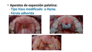• Aparatos de expansión palatina:
- Tipo Hass modificado o Hyrax.
- Férula adherida
 