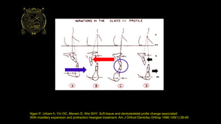 Ngan P, Urbam h, Yin OC, Merwin D, Wei SHY. Scft tissue and dentoskeletal profie change associated
With maxillary expansion and protraction heargear treatment. Am J Orthod Dentofac Orthop 1996;109(1):38-49
 