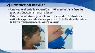 2) Protracción maxilar
• Una vez realizada la expansión maxilar se inicia la fase de
protracción, con la máscara facial.
• Ésta se encuentra sujeta a la cara por medio de elásticos
estirados, que van desde los ganchos de la férula adherida a
la barra transversa de la máscara facial.
 