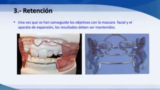 3.- Retención
• Una vez que se han conseguido los objetivos con la mascara facial y el
aparato de expansión, los resultados deben ser mantenidos.
 