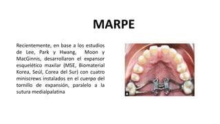 Recientemente, en base a los estudios
de Lee, Park y Hwang, Moon y
MacGinnis, desarrollaron el expansor
esquelético maxilar (MSE, Biomaterial
Korea, Seúl, Corea del Sur) con cuatro
miniscrews instalados en el cuerpo del
tornillo de expansión, paralelo a la
sutura medialpalatina
MARPE
 