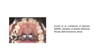 Suzuki et al, cambiaron el Aparato
MARPE, dándole un diseño diferente
Peclab, Belo Horizonte, Brasil.
 