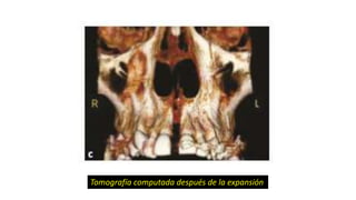 Tomografía computada después de la expansión
 