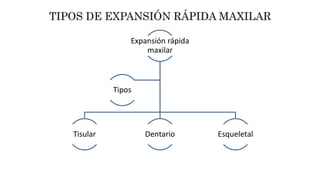 Expansión rápida
maxilar
Tisular Dentario Esqueletal
Tipos
 