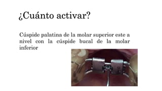 ¿Cuánto activar?
Cúspide palatina de la molar superior este a
nivel con la cúspide bucal de la molar
inferior
 
