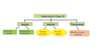 Maloclusión Clase III
Sagital Vertical Transversal
Prognatismo
mandibular
Mordida
profunda
Mordida
abierta
Mordida cruzada
posterior
Retrusión
maxilar
 
