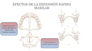 Apertura en V
hacia adelante a
través del
proceso maxilar
Inclinación de
piezas hacia bucal
 