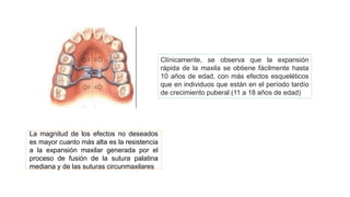 Clínicamente, se observa que la expansión
rápida de la maxila se obtiene fácilmente hasta
10 años de edad, con más efectos esqueléticos
que en individuos que están en el período tardío
de crecimiento puberal (11 a 18 años de edad)
La magnitud de los efectos no deseados
es mayor cuanto más alta es la resistencia
a la expansión maxilar generada por el
proceso de fusión de la sutura palatina
mediana y de las suturas circunmaxilares
 