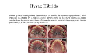 Wilmes y otros investigadores desarrollaron un modelo de expansor apoyado en 2 mini-
implantes insertados en la región anterior paramediana de la sutura palatina anclados
más tarde en los primeros molares. Como este aparato expansor tiene apoyo en dientes
y en hueso, fue denominado de Hyrax híbrido.
Hyrax Hibrido
 