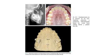 04. A-C - Establecimiento de
la posición de los mini-
implantes anteriores y
posteriores. Telerradiografía
lateral (A). Límite entre
paladar blando y paladar
duro (B).
 