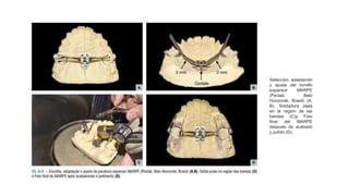 Selección, adaptación
y ajuste del tornillo
expansor MARPE
(Peclab, Belo
Horizonte, Brasil) (A,
B). Soldadura plata
en la región de las
bandas (C)y Foto
final del MARPE
después de acabado
y pulido (D).
 
