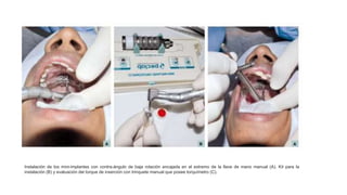 Instalación de los mini-implantes con contra-ángulo de baja rotación encajada en el extremo de la llave de mano manual (A). Kit para la
instalación (B) y evaluación del torque de inserción con trinquete manual que posee torquímetro (C).
 