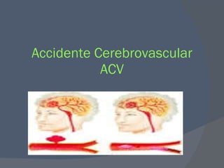 Accidente Cerebrovascular ACV 