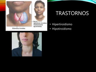 TRASTORNOS
• Hipertiroidismo
• Hipotiroidismo
 