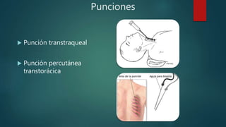 Punciones
 Punción transtraqueal
 Punción percutánea
transtorácica
 
